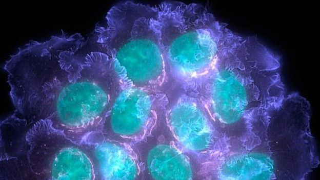 150528090722_breast_cancer_624x351_spl_n