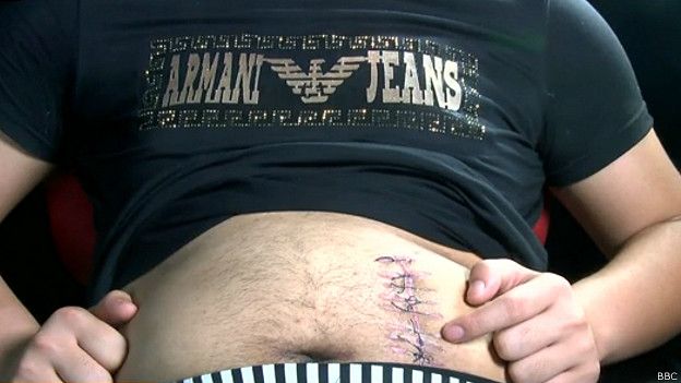 Cicatriz de donación de riñón