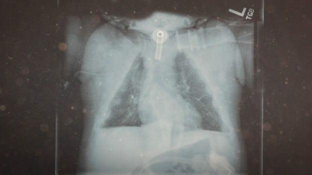 Radiografía del pecho de Janelly a los 18 meses