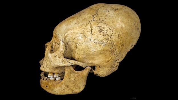 151126120636_skull_reshaping_5.jpg