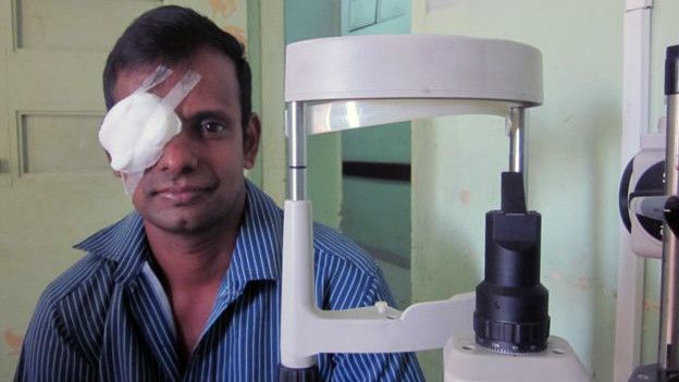 கருவிழிப்படலம் தானமாக கிடைத்ததால் பார்வை திரும்பப்பெற்ற பரமன் மஹாலிங்கம்