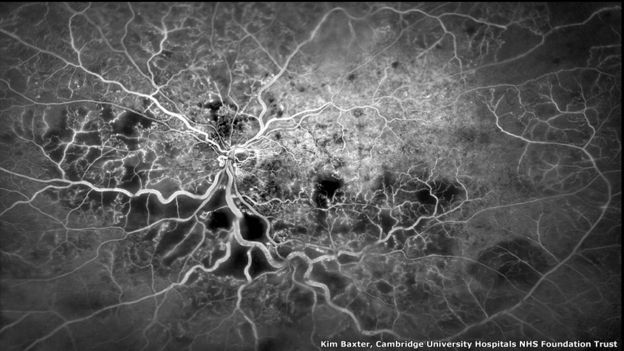 Vasos sanguíneos en el ojo. Kim Baxter, Universidad de Cambridge