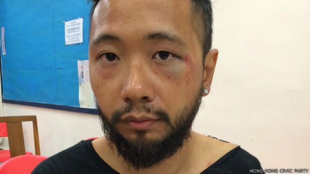 Zeng Jian Chao face significant bruising (Hong Kong Civic Party provide photographs 15/10/2014)