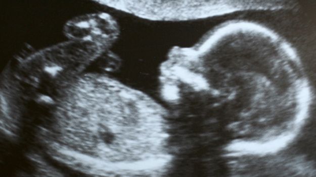 Ultrassom de bebê humano