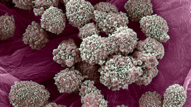 العلاج المناعي يمثل "طفرة" محتملة في علاج السرطان