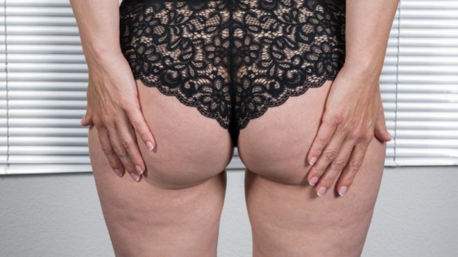 Celulitis