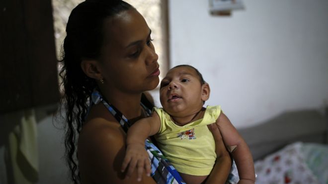 一名巴西婦女抱著患上小頭症的孩子