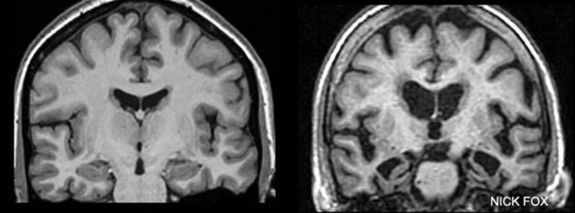 Escáneres de una persona sana y otra con Alzheimer