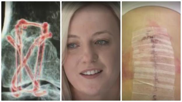 Skater 'smashed her knee into eight pieces'