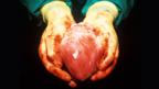 Human heart transpolant (SPL)