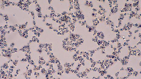 If you have too much yeast in your belly, strange things start to happen (SPL)