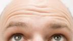 Clue to male baldness discovered