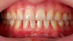 Does age damage your gums?