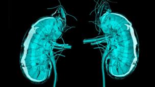 3D printed kidneys