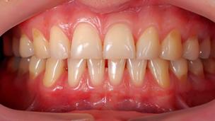 Does age damage your gums?