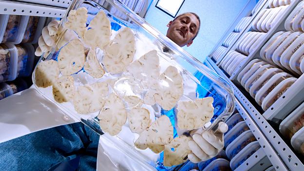 Autism: Banking on new brain donors