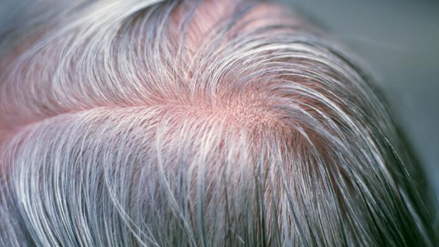 Can stress turn your hair grey overnight?