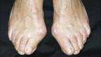 Bunions on a woman's feet