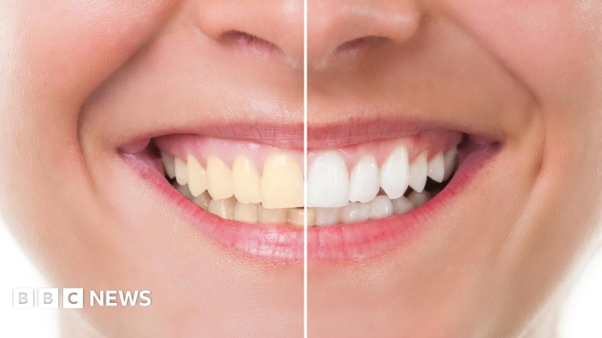 Before and after whitening picture of teeth