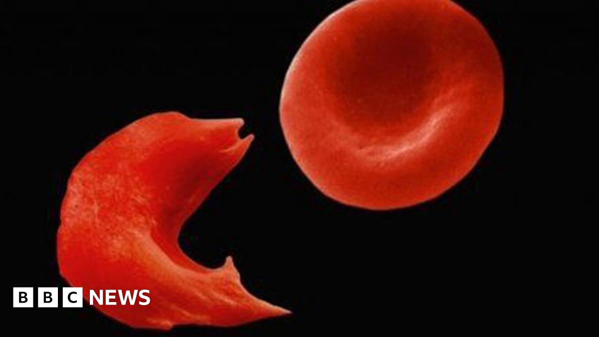 Sickle cell gene therapy: 'It gives me joy and hope'