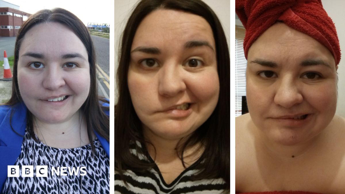 Bell's palsy: 'I have same condition as Tulisa on I'm A Celeb - BBC News