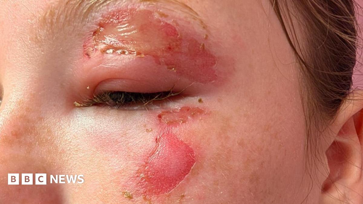 'Serious burn' warning after children heat squishy toys in microwaves