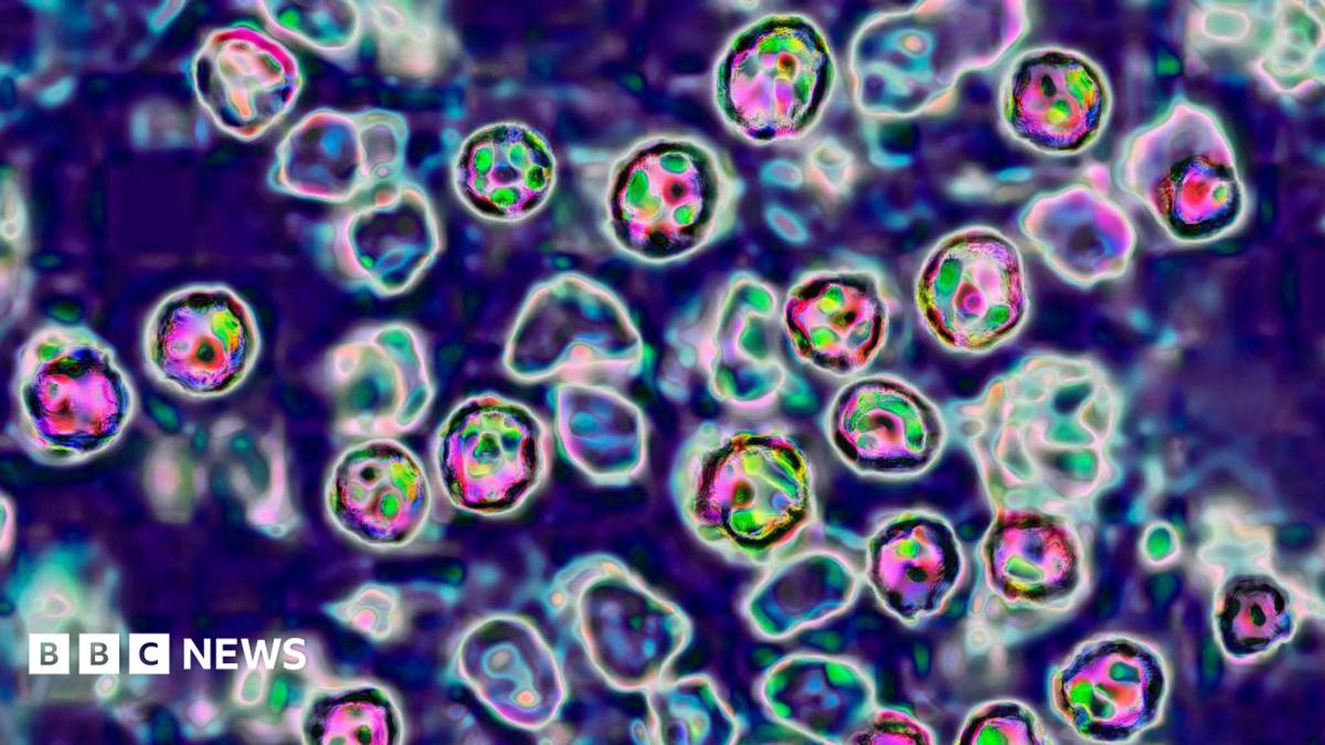 米国の麻疹の発生は、ニューメキシコ州テキサスで100近く病気になります