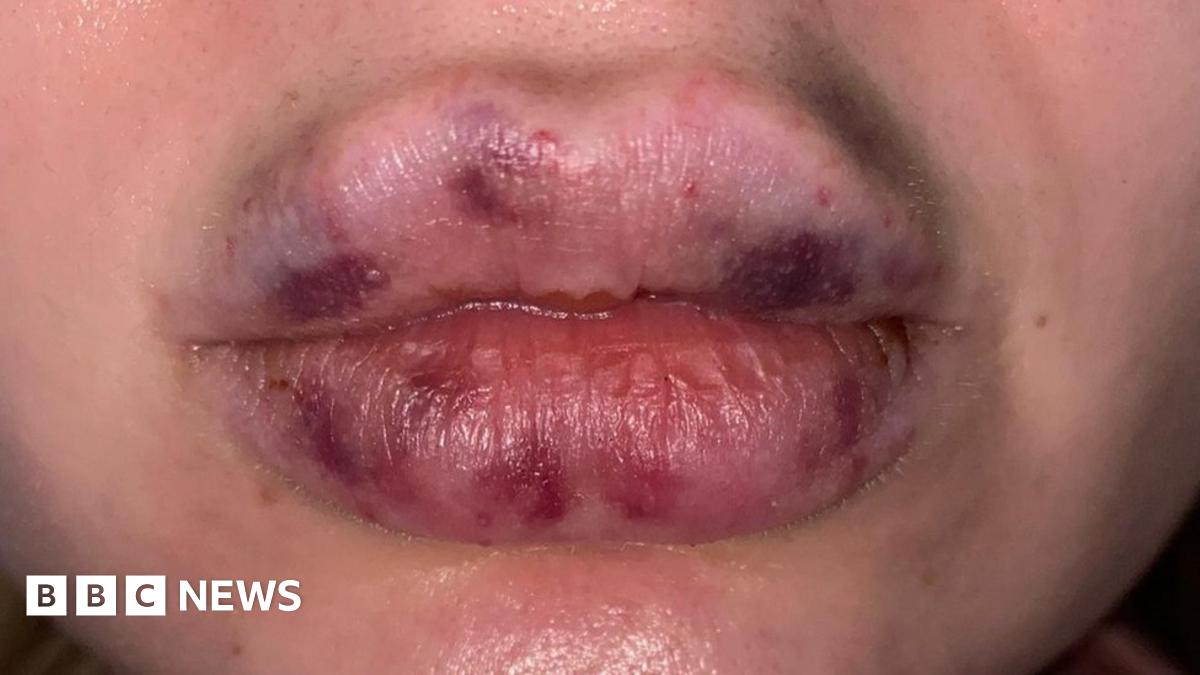 Lockdown lip fillers gone wrong: 'My lips went black'