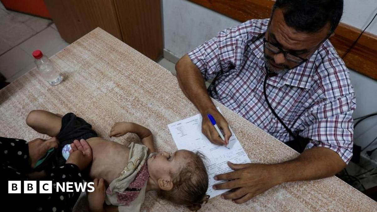 A Palestinian girl is examined by a doctor amid fears over the spread of polio in Gaza after the first case was reported by the enclave's Ministry of Health, as the war between Israel and Hamas continues, at Al-Aqsa Martyrs Hospital, in Deir Al-Balah i...