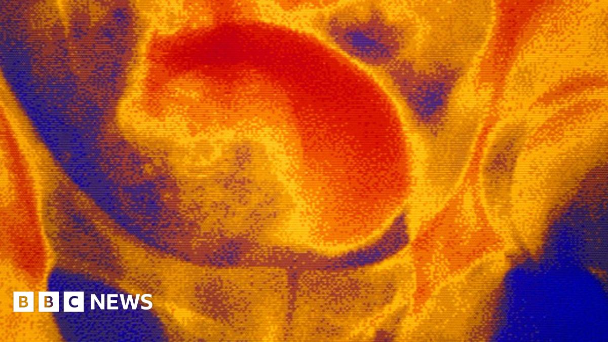 New prostate therapy recommended on NHS - BBC News
