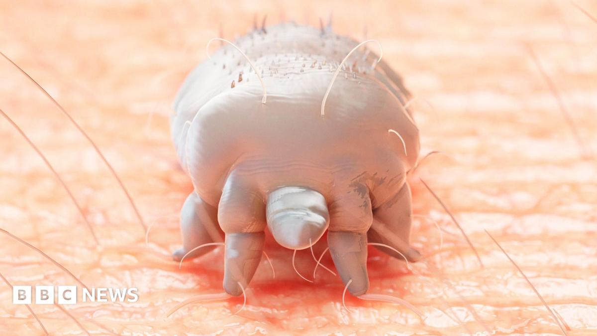 Hospital ward closed after highly contagious crusted scabies outbreak