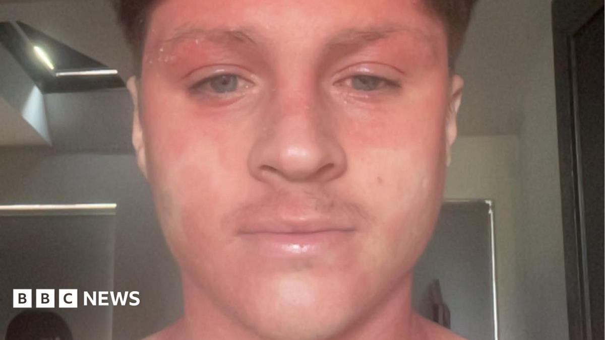 Skin cream withdrawal pain 'like being electrocuted' left footballer stuck in bed