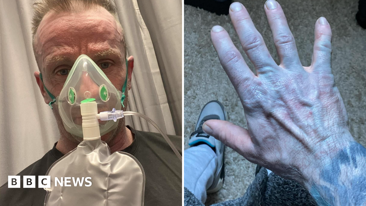 
                            Man's blue skin A&E panic was just bed sheet dye