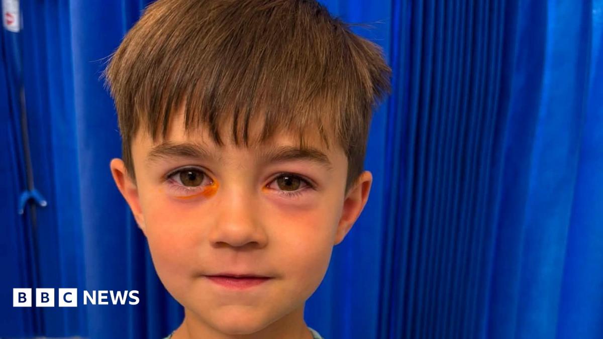 Boy, four, taken to hospital after fake squishy toy explodes in his face