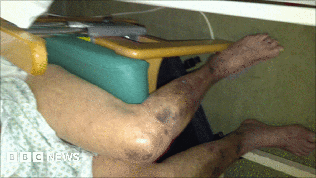 Hospitals warned over Deep Vein Thrombosis (DVT) deaths - BBC News