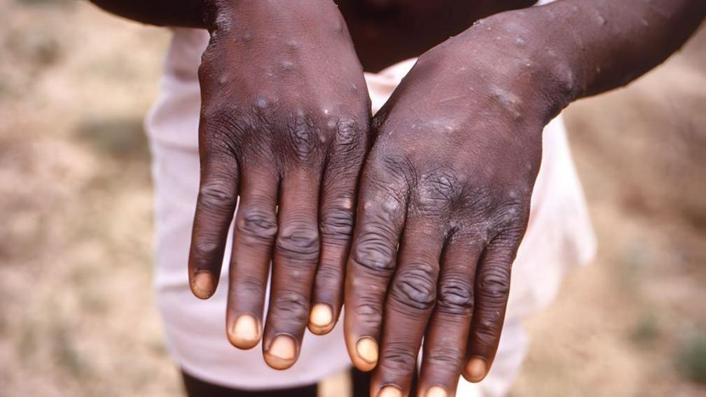 A person from the Democratic Republic of Congo in a previous outbreak of mpox holds their hands out in front of their body, which are covered with a rash, as if showing them to the photographer