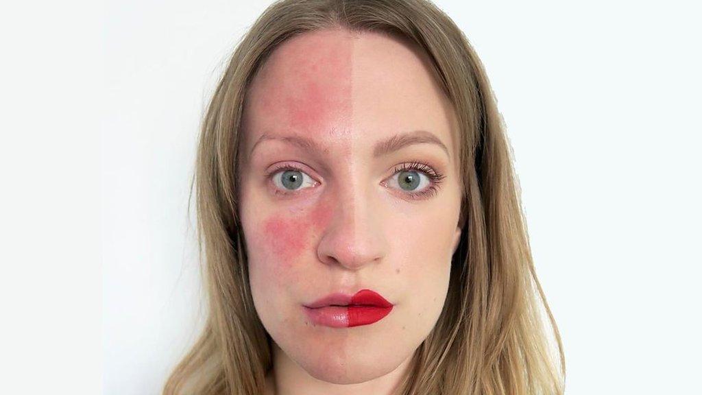 Lex with half her face with make-up, half with rosacea.