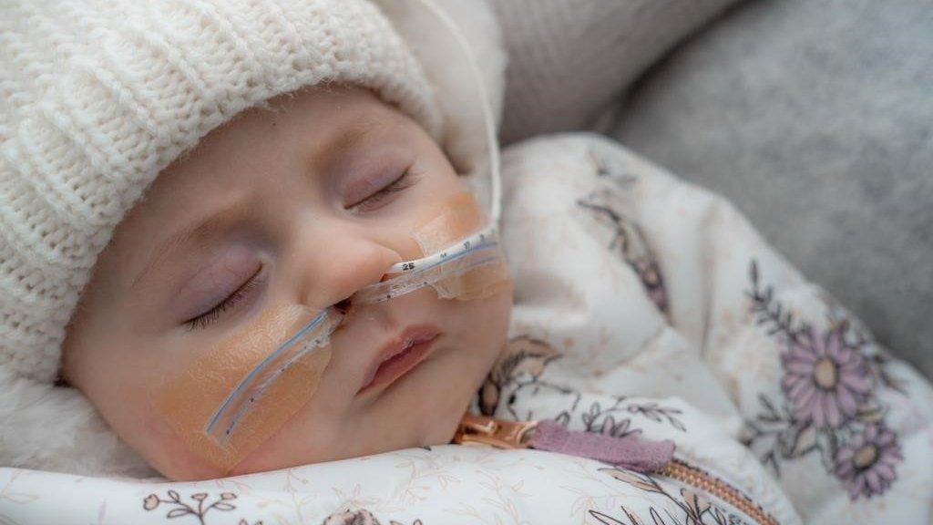 A sleeping baby with a feeding tube in her nose