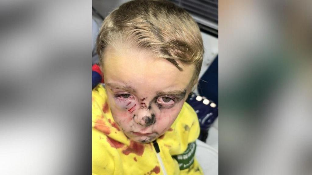 Roman, just after the attack. There is blood on his yellow top and his face is badly bruised and scarred.