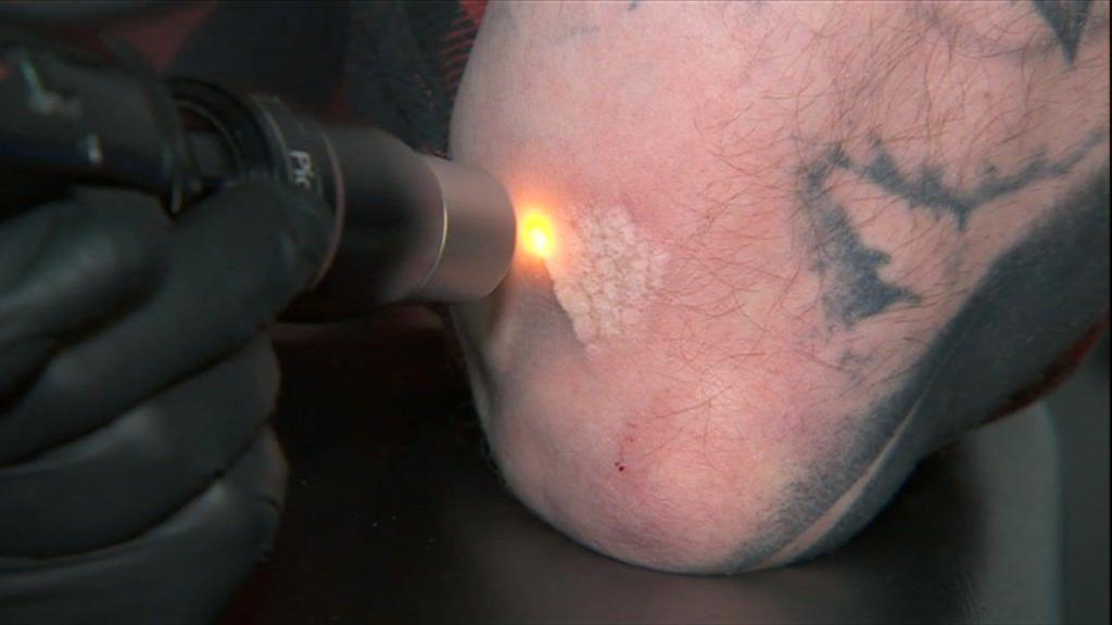 A close-up of a red laser dot directed at a tattoo on a man's arm. It is unclear what the tattoo was of, but you can see an area of black ink. Where the laser has already been directed, the skin is slightly raised and white.