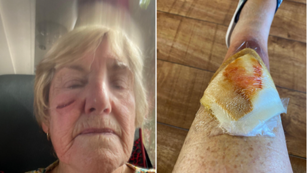 A collage of two images showing Mrs Millet's face and leg injuries. The leg is bandaged and the area under the eye is stitched.