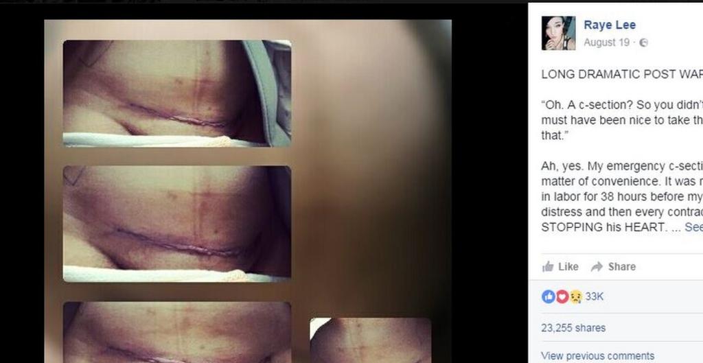 Surgical scars from C-section