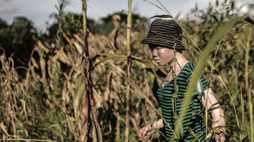 An albino walking in a field in Malawi