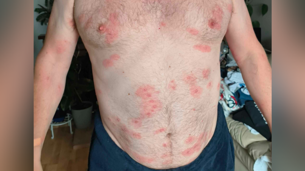 Man's torso with many stings