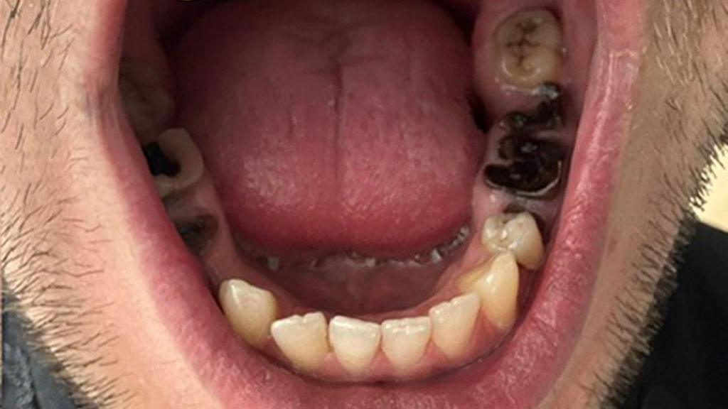 Inside Mr Csendes' mouth, a bottom row of teeth can be seen. He has seven teeth at the front, and a few at the back. There are teeth with black marks in the middle. 