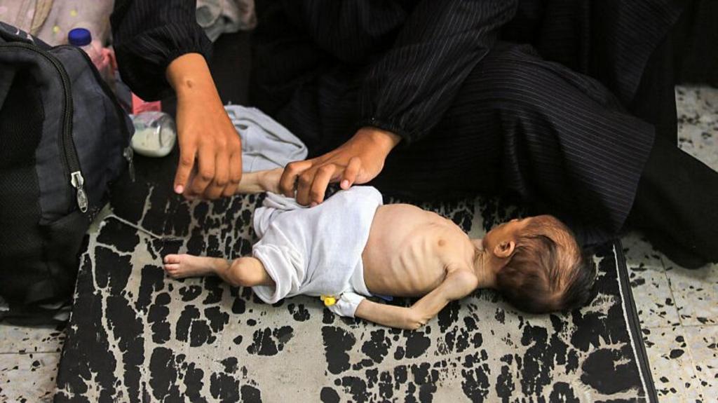  Palestinian mother holds her child, who has been losing weight due to malnutrition, at Nasser Hospital in Khan Yunis, Gaza, on July 24, 2025. T