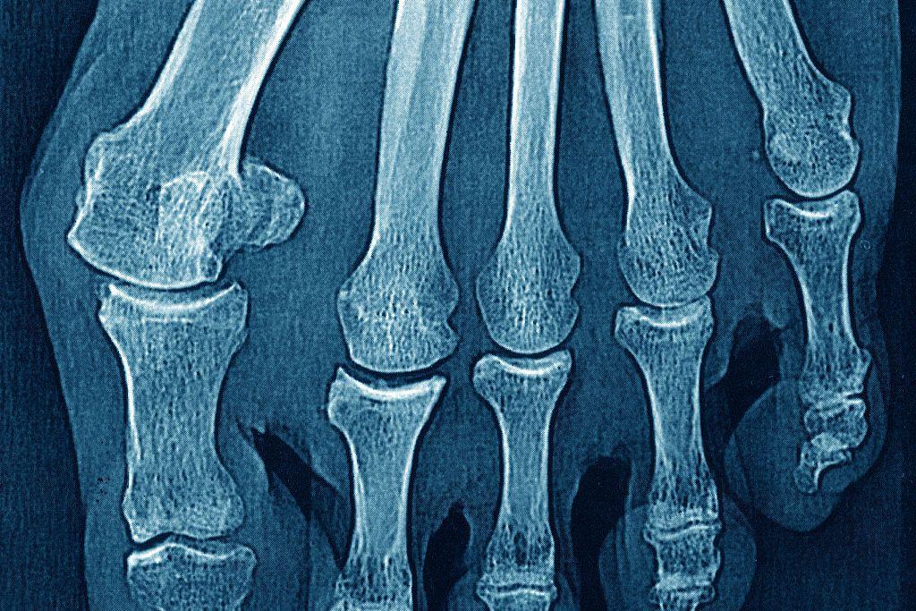 Hallux valgus on the big toe, seen on an x-ray of the right foot. 