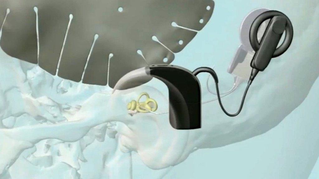 Computer image of a cochlear implant