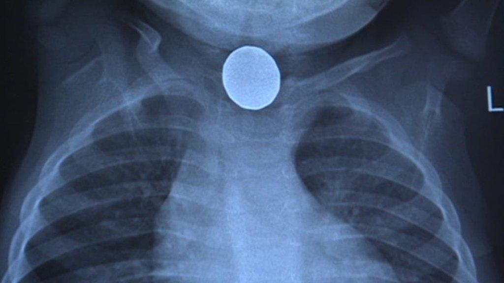 X-ray of a battery lodged in a child's throat