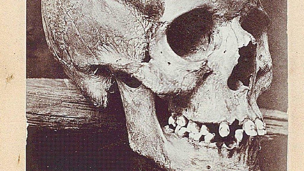 The skull from the grave was displayed at St Andrews University Museum